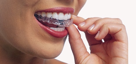マウスピース型矯正治療法（インビザライン矯正システム）では簡単に歯から取り外すことができる
